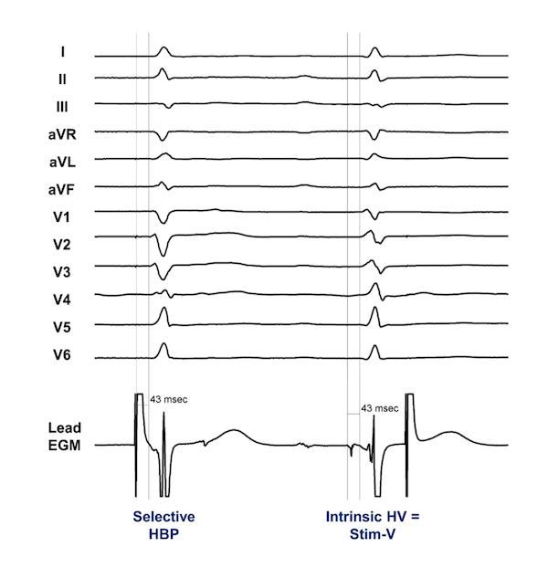 Conduction System Pacing EP Lab Digest